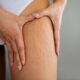 Cellulite gambe, rimedi