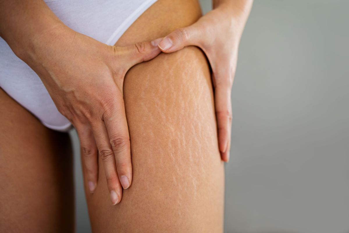 Cellulite gambe, rimedi