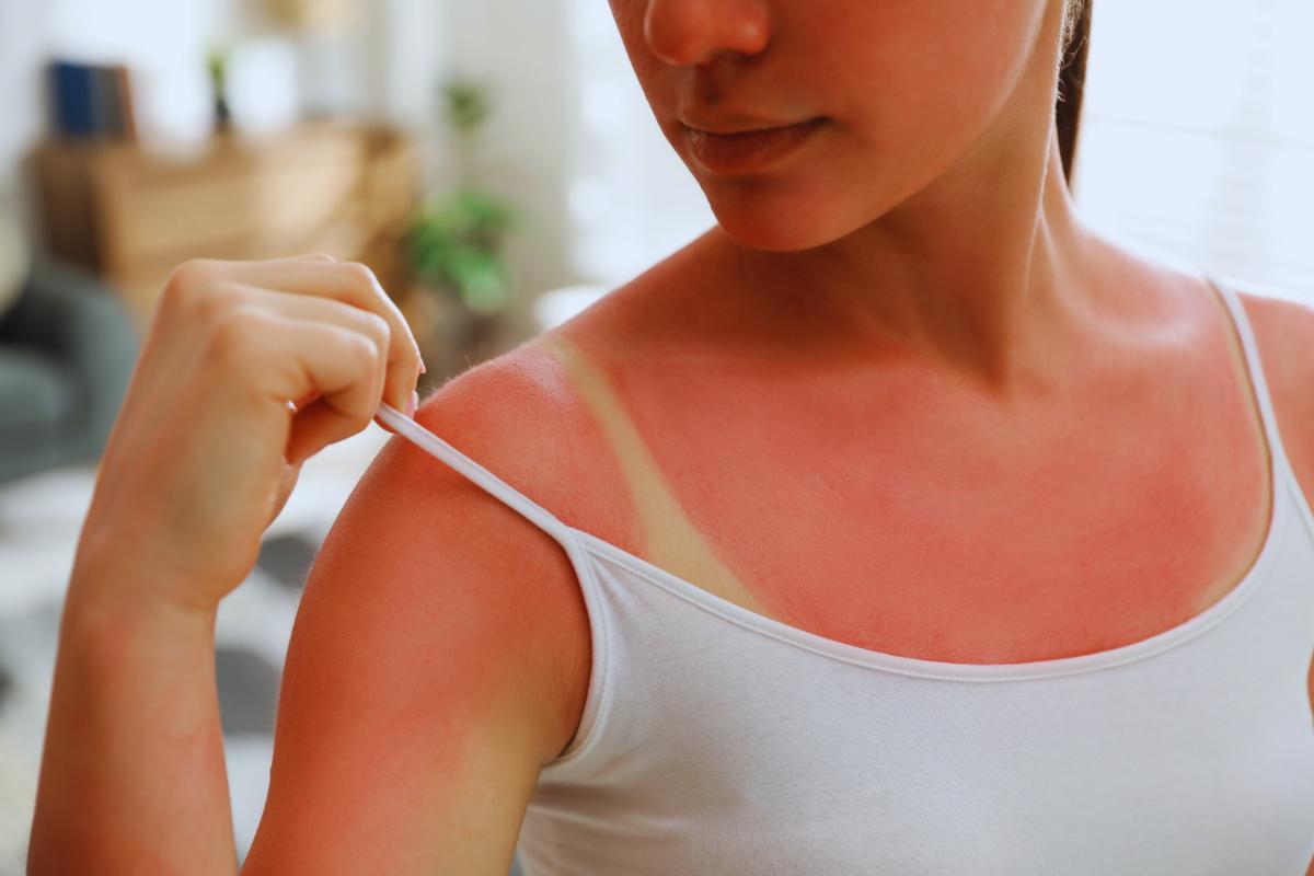 Primo sole e scottatura assicurata: risolvi con questi 6 doposole homemade