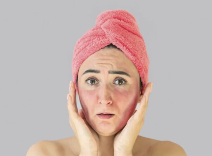 Nonostante la vasta offerta di prodotti cosmetici e farmaceutici per prevenirle e alleviarle, esiste un rimedio naturale semplice ed efficace,