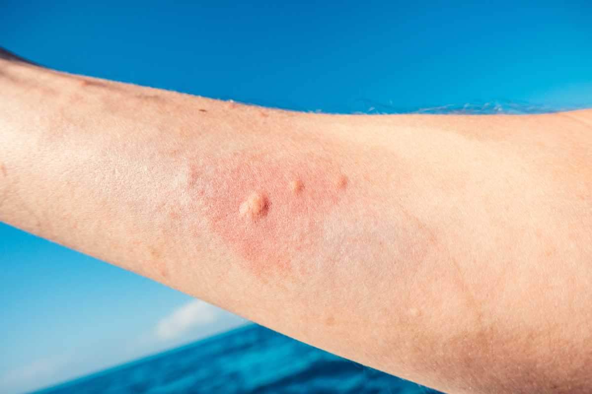 Puntura medusa soluzioni