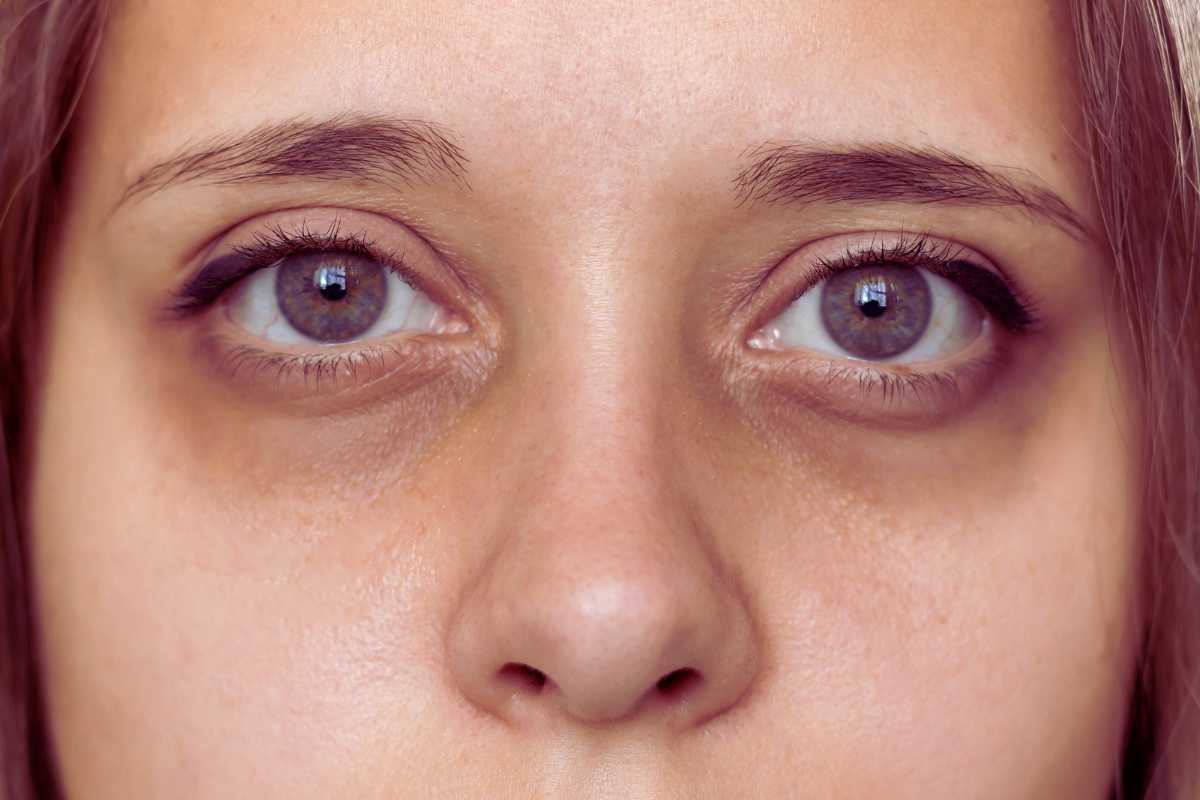 rimedio casalingo che fa sparire le borse sotto gli occhi