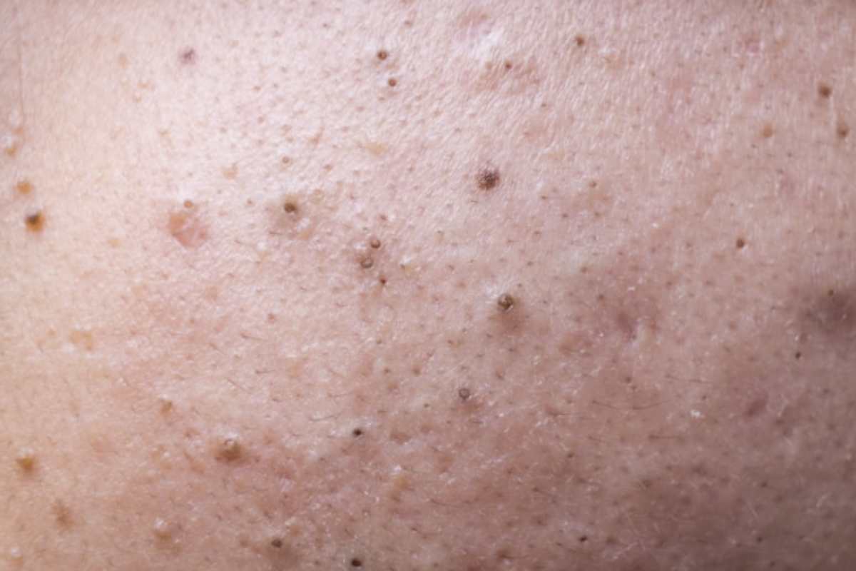 Per mantenere in salute la pelle e ridurre la comparsa dei punti neri, è fondamentale adottare una routine di cura quotidiana mirata e rispettosa del naturale equilibrio cutaneo.
