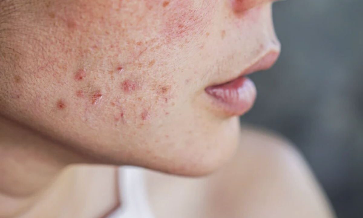 La loro insorgenza è legata a molteplici fattori che interessano il funzionamento delle ghiandole sebacee e la salute dei follicoli piliferi.
