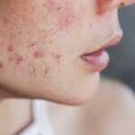 La loro insorgenza è legata a molteplici fattori che interessano il funzionamento delle ghiandole sebacee e la salute dei follicoli piliferi.