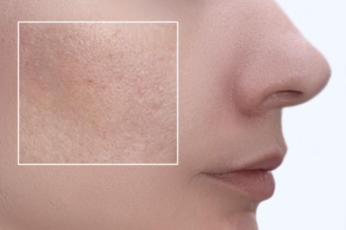 Oltre ai trattamenti cosmetici e dermatologici, uno stile di vita sano supporta la salute della pelle e contribuisce a limitare la dilatazione dei pori.