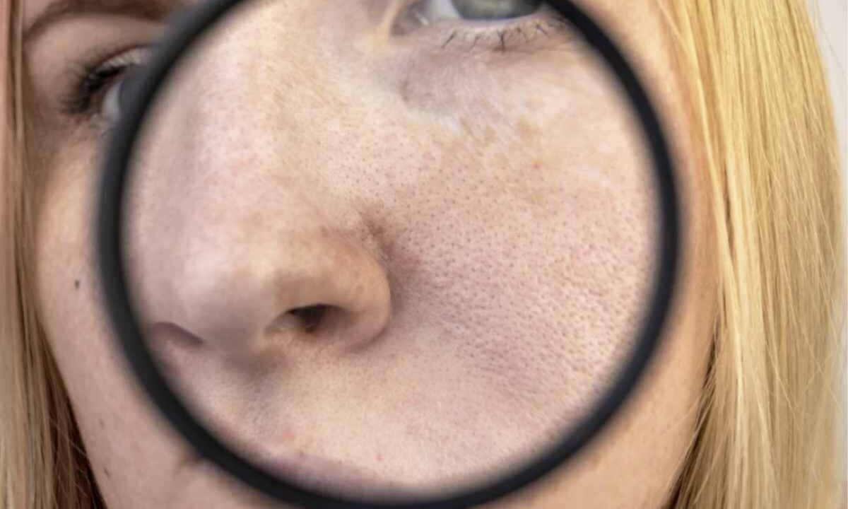 Benché siano una caratteristica naturale della pelle, la loro visibilità può aumentare per molteplici cause, generando disagio estetico.