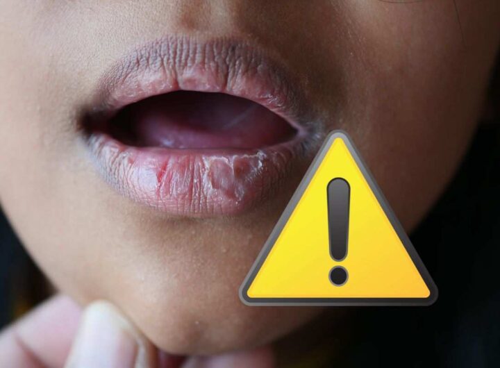 labbra screpolate: i rimedi