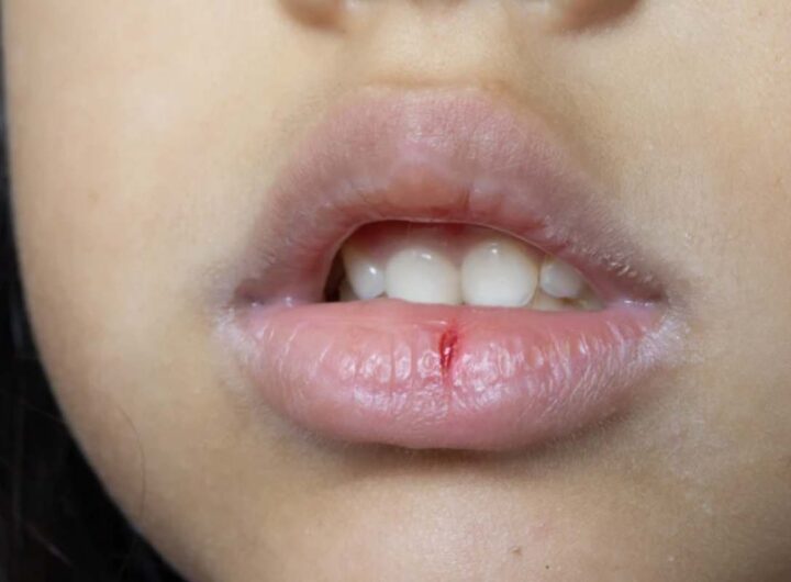 Le temperature fino a 8 gradi sotto la media stagionale, accompagnate da vento gelido, pioggia e neve, mettono infatti a dura prova la pelle delle labbra