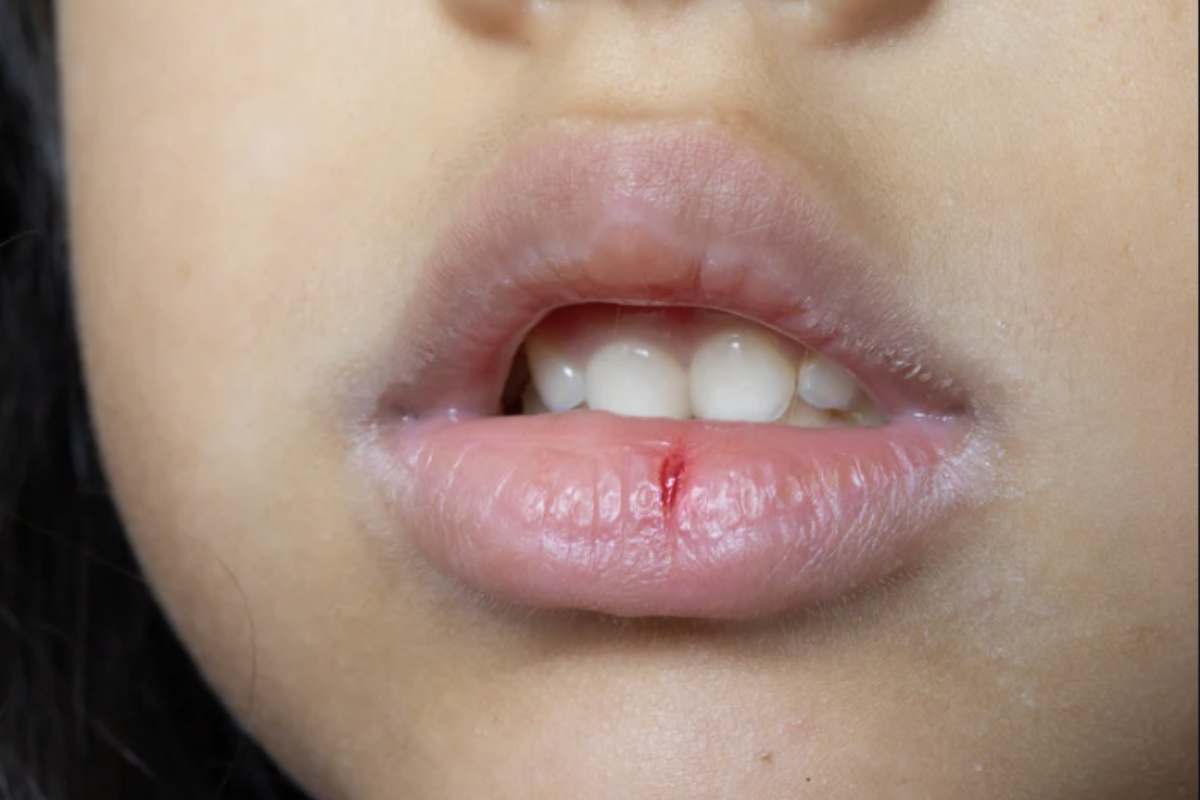 Le temperature fino a 8 gradi sotto la media stagionale, accompagnate da vento gelido, pioggia e neve, mettono infatti a dura prova la pelle delle labbra